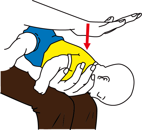 Infant back blows illustration